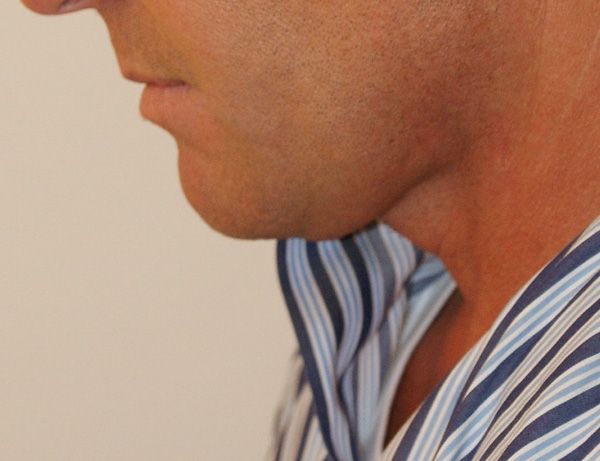 Photo of Patient 02 After Short Scar Neck Lift Procedure