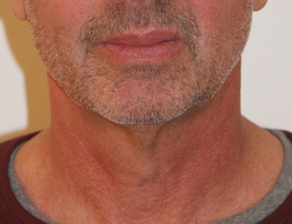 Photo of Patient 03 Before Short Scar Neck Lift Procedure