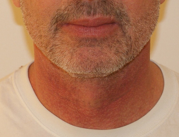 Photo of Patient 03 After Short Scar Neck Lift Procedure