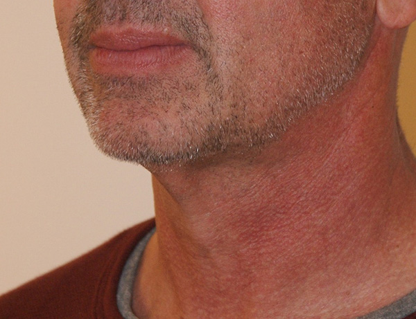 Photo of Patient 03 Before Short Scar Neck Lift Procedure