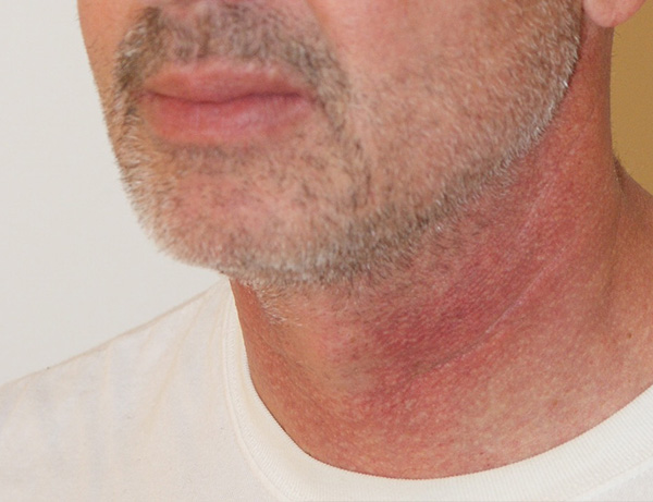 Photo of Patient 03 After Short Scar Neck Lift Procedure