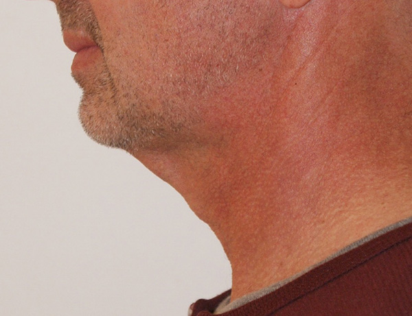 Photo of Patient 03 Before Short Scar Neck Lift Procedure