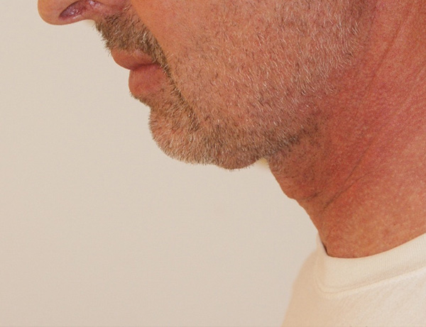 Photo of Patient 03 After Short Scar Neck Lift Procedure