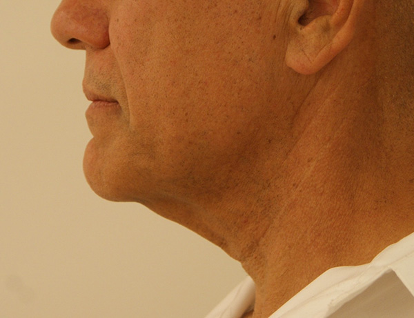 Photo of Patient 04 Before Short Scar Neck Lift Procedure
