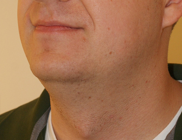 Photo of Patient 05 Before Short Scar Neck Lift Procedure