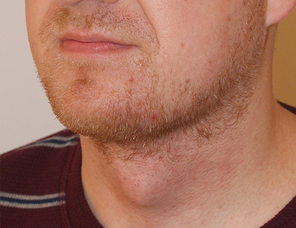 Photo of Patient 05 After Short Scar Neck Lift Procedure