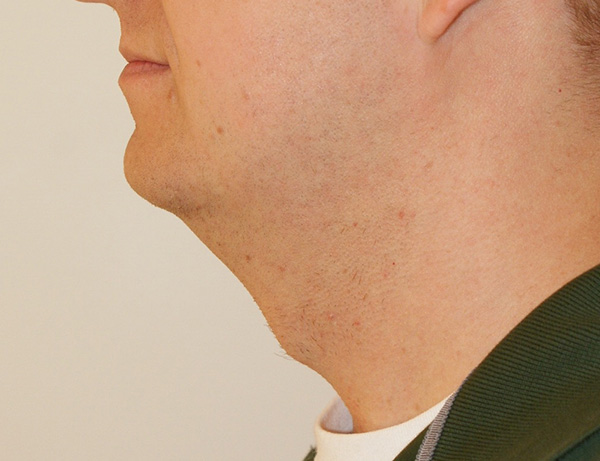 Photo of Patient 05 Before Short Scar Neck Lift Procedure