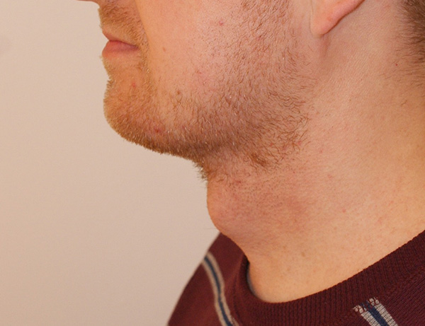 Photo of Patient 05 After Short Scar Neck Lift Procedure