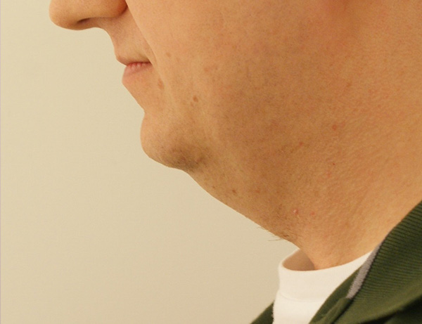 Photo of Patient 05 Before Short Scar Neck Lift Procedure