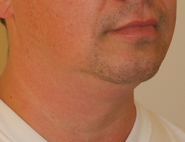 Photo of Patient 06 Before Short Scar Neck Lift Procedure