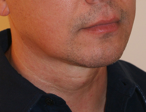 Short Scar Neck Lift Before and After | Dino Elyassnia, MD