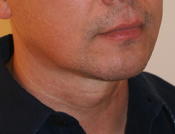 Photo of Patient 06 After Short Scar Neck Lift Procedure