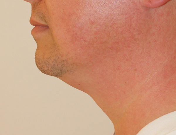 Photo of Patient 06 Before Short Scar Neck Lift Procedure