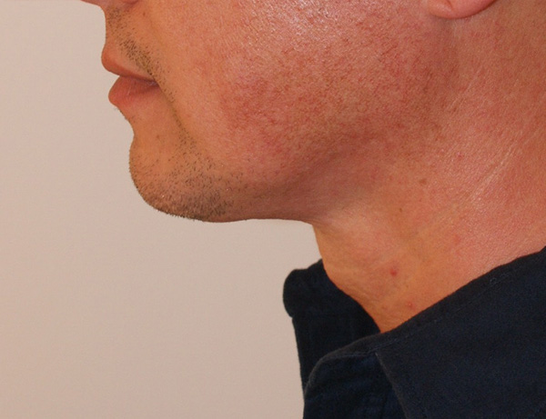 Photo of Patient 06 After Short Scar Neck Lift Procedure