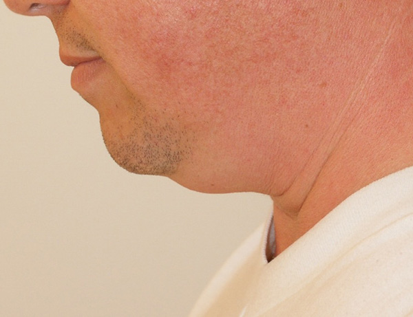 Photo of Patient 06 Before Short Scar Neck Lift Procedure