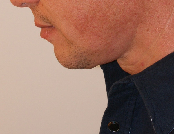 Photo of Patient 06 After Short Scar Neck Lift Procedure