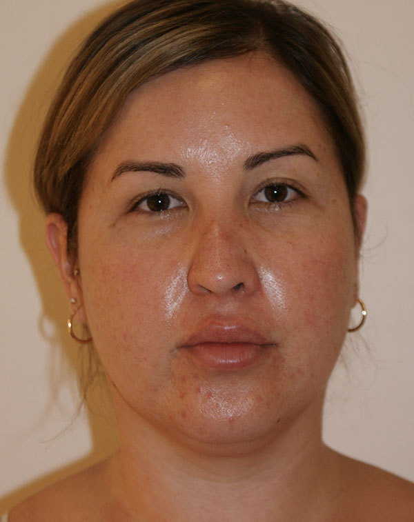 Photo of Patient 07 Before Short Scar Neck Lift Procedure