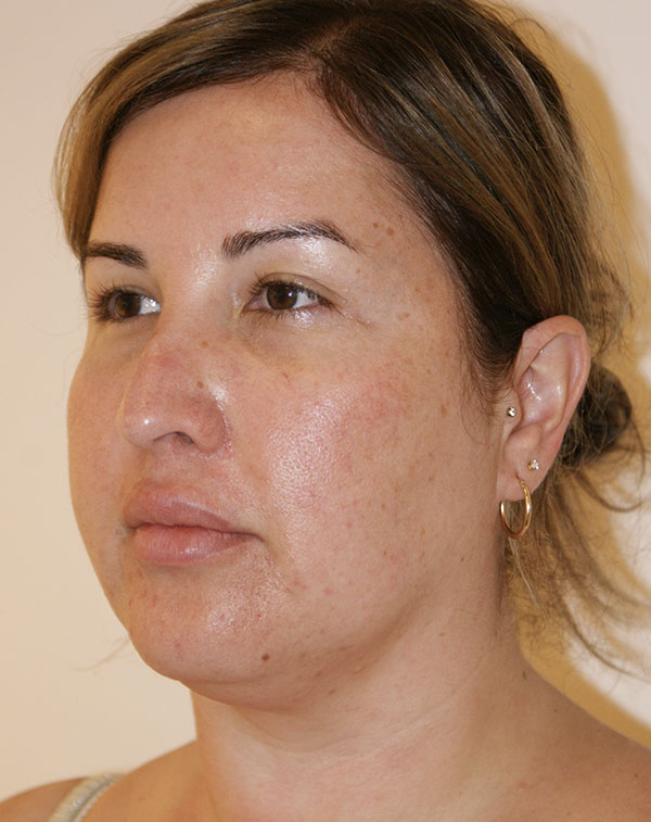 Photo of Patient 07 Before Short Scar Neck Lift Procedure