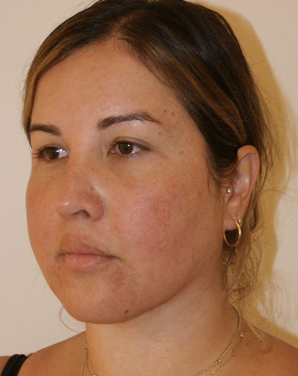 Photo of Patient 07 After Short Scar Neck Lift Procedure