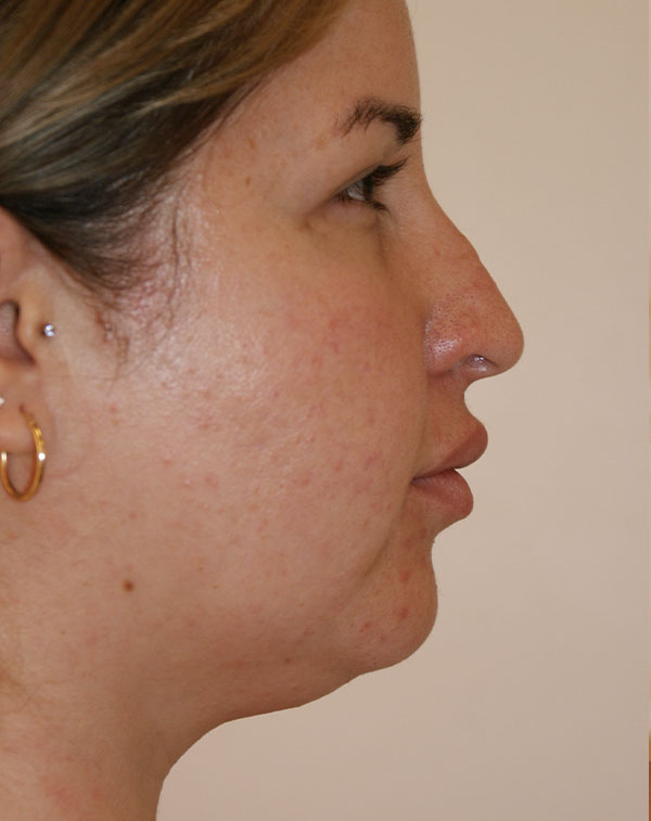 Photo of Patient 07 Before Short Scar Neck Lift Procedure