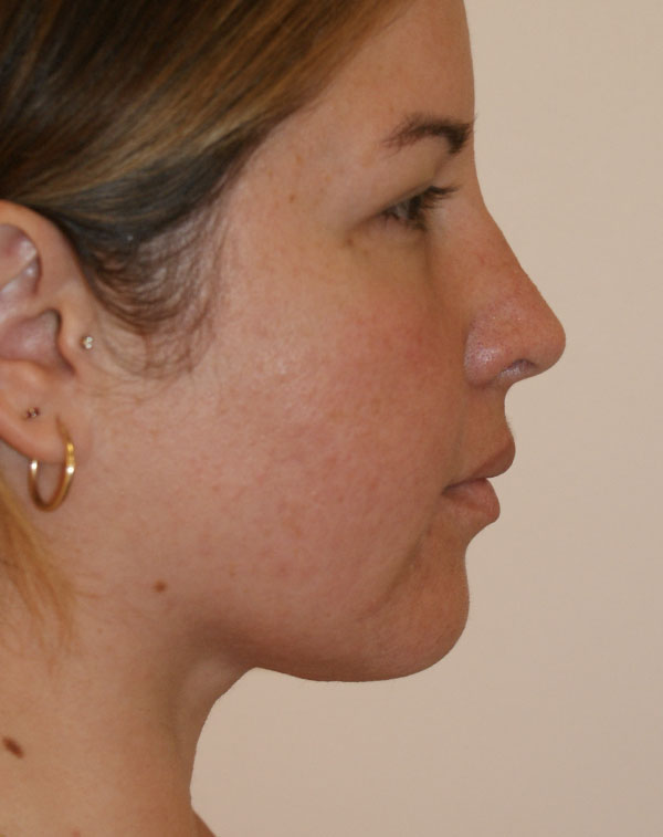 Photo of Patient 07 After Short Scar Neck Lift Procedure