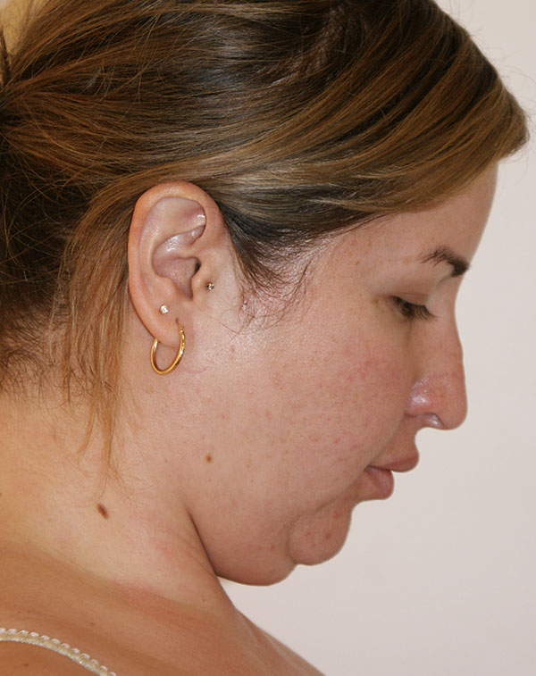 Photo of Patient 07 Before Short Scar Neck Lift Procedure