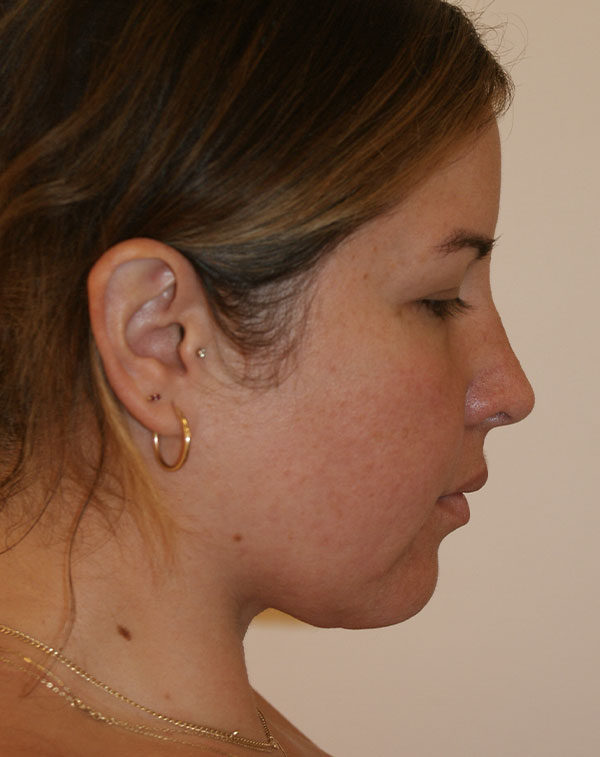 Photo of Patient 07 After Short Scar Neck Lift Procedure