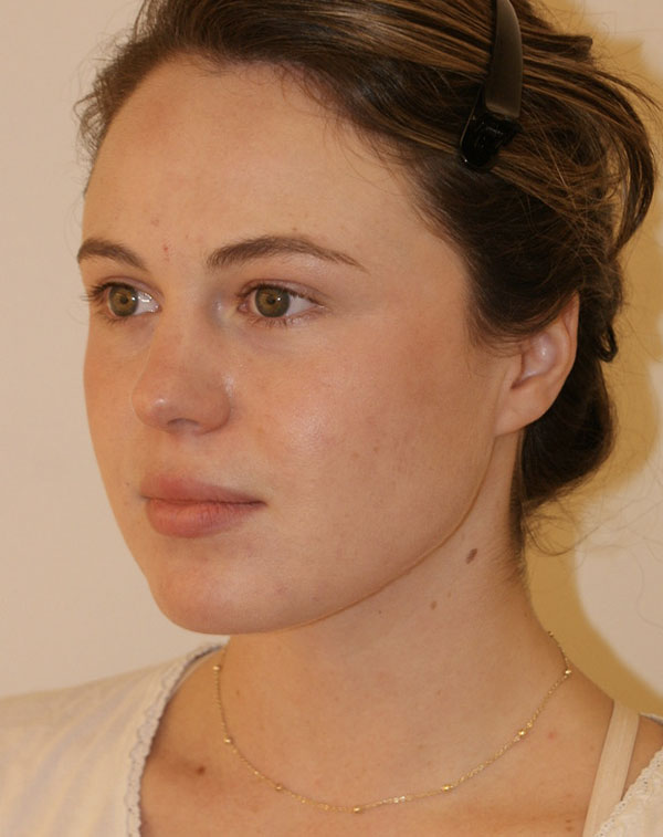 Photo of Patient 08 After Short Scar Neck Lift Procedure