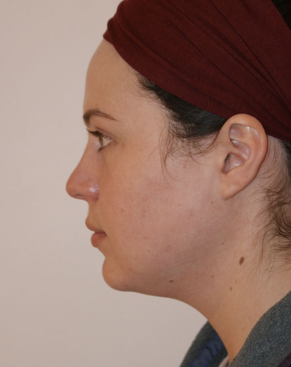 Photo of Patient 08 Before Short Scar Neck Lift Procedure