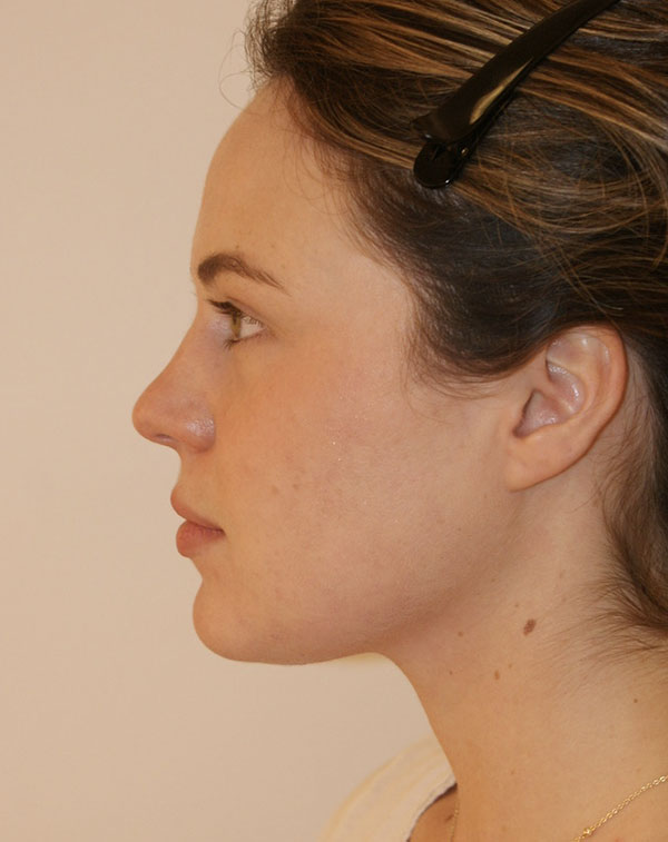 Photo of Patient 08 After Short Scar Neck Lift Procedure