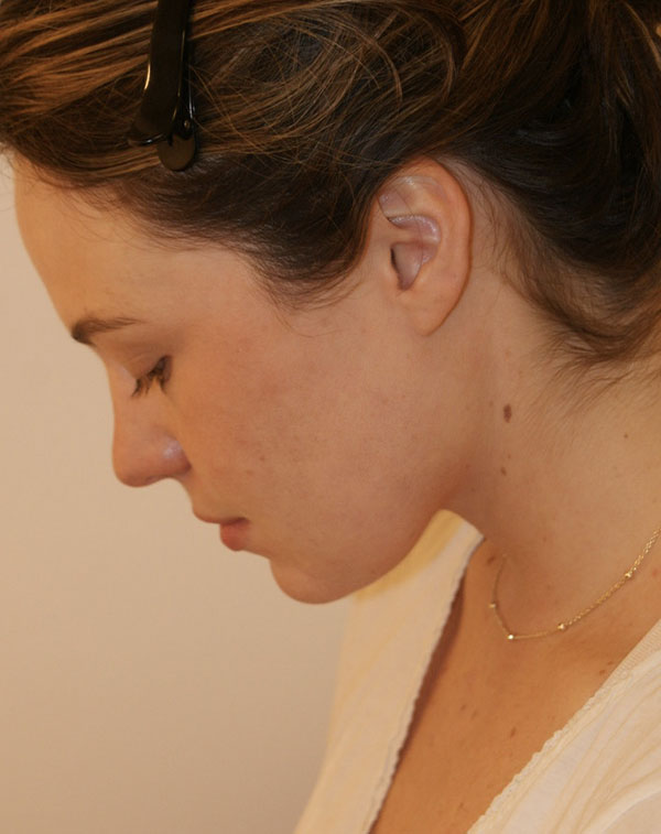 Photo of Patient 08 After Short Scar Neck Lift Procedure